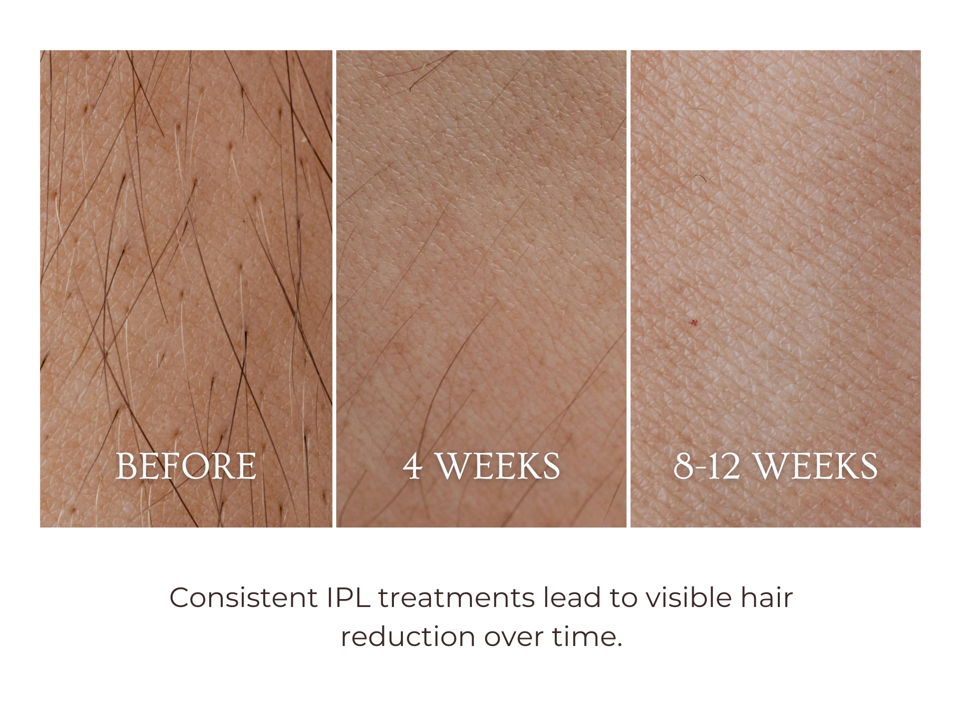 laser hair removal hair removal device hair removal philipslumea bikini zone bumps shaving hair waxing facial hair permanent hair removal for men lasergeräte haarentfernung intimbereich lasern elektroepilation bikinizone intimrasur rasierpickel dauerhafte haarentfernung diodenlaser braun laser ipl gerät permanente haarentfernung haarentfernung laser kosten haare lasern armhaare ice cooling 500000 flashes exchangable head cheap high quality viral tiktok product leg hair beinbehaarung entfernen lazern